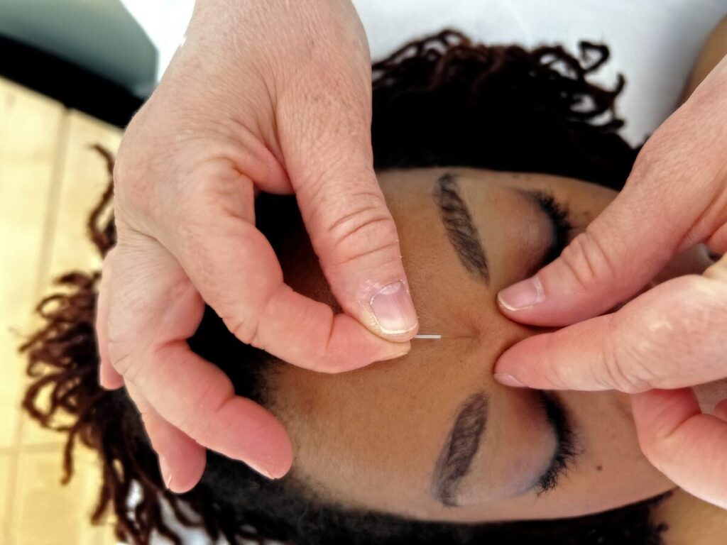 An acupuncture needle placed between the brows at The Teal Center Arlington