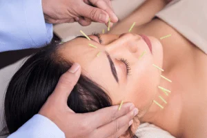 Fine facial acupuncture needles placed across the face during a cosmetic acupuncture session